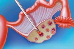 取卵流程大揭秘！原来这么简单，别再自己吓自己了！