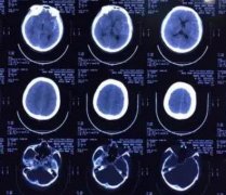 宝宝可以脑部ct吗?宝宝做CT危害介绍