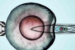 宫颈活检cln1可以试管！宫颈cln1一定需要治疗吗？