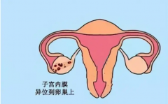 子宫内膜异位影响大吗？重度异位很严重！