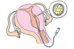 输卵管结扎后还能做试管么?听听专家怎么说