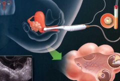 来宾兴宾区试管去哪家?从哪些方面考虑?