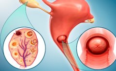 输卵管堵塞怎么办?哪些食物可以帮助?