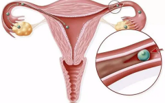 宫腔“小缝隙”揭秘：4mm分离，你了解多少？