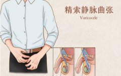 收藏！双侧精索静脉曲张手术护理需要注意这些