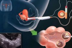 有智齿，要取卵怎么办?