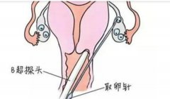 取卵细针穿刺和粗针穿刺不一样，这些不同需要了解