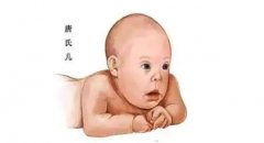 唐氏高危典型特征是面部特征，孩子是否保留由家庭情况决定