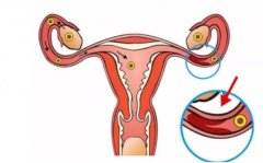 输卵管积水是怎么回事？对人体有什么影响？