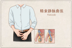 睾丸“小曲奇”的冒险：精索静脉曲张的危害与严重后果