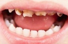 孩子还小有蛀牙洞咋办?有什么好的治疗办法?