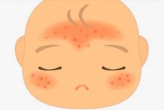 新生儿红疹多久会显现，要怎么治疗？