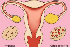 多囊卵巢综合征患者能怀孕吗？如何治疗提高受孕机会？