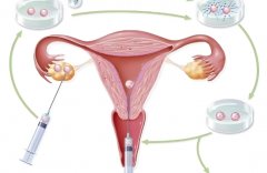 降调针是什么?为什么试管长方案要打降调针?