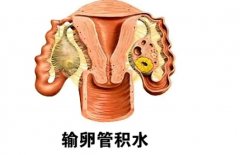输卵管有积水怎么治疗?输卵管有积水会自愈吗？