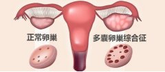得了多囊卵巢综合征很难当妈妈？中医说应该这样治！