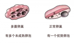 多囊卵巢患者能怀孕吗？试管技术效果好