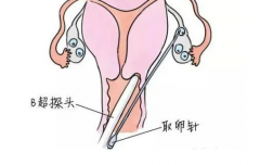 【科普】详解试管取卵过程，两步即可完成