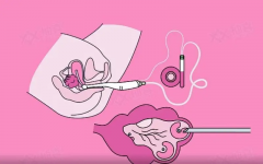 试管取卵的最佳时机：月经后的关键日期解读