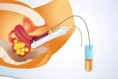 试管取卵过程详解：从控制排卵到穿刺取卵