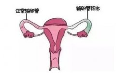 输卵管积水怎么能查出来？对女性有什么危害？