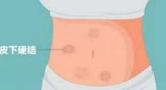 注意！打肝素硬块消除淤青前一定要做皮肤测试