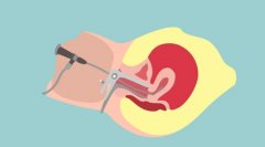 试管副作用：取卵后腹水症状，怎么治疗？