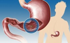 一文带你了解胃囊病的症状，控制胃囊病要加强饮食管理