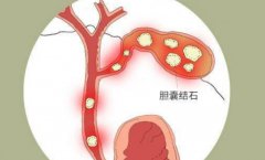 胆囊症是怎么引起的，严重吗？要怎么治疗？