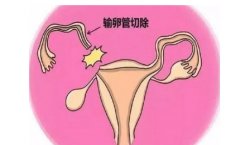 注意！输卵管切除术会对胚胎着床能力产生影响