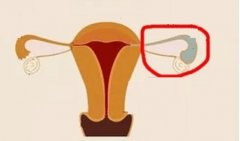 输卵管积水做试管需要注意什么？有什么影响？