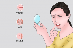 疱疹病毒来袭，这些症状你中招了吗？