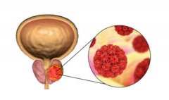 前列腺癌晚期的症状,如何应对前列腺癌晚期？