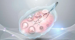 试管胚囊移植失败几种典型症状盘点，附失败原因