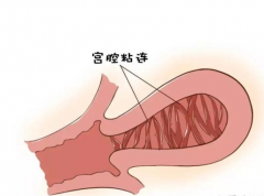 宫腔粘连手术后多久能做试管？一般需2-3个月时间