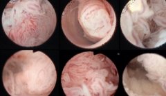 内膜检查很重要，一文了解内膜检查的两种类型