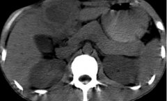 肛门里有没有子宫？一文了解肛门里可能存在的结构