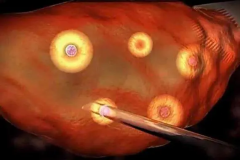 提升试管取卵获卵率！取卵前后的关键注意事项与细节