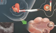 子宫腺肌症对试管成功率有何影响?子宫腺肌症怎么办?