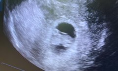 什么是试管移植宫腔镜?试管移植宫腔镜主要是做什么?