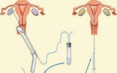 试管费用如何计算，可以报销吗？