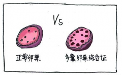多囊卵巢综合症能做试管吗？有多少成功把握？