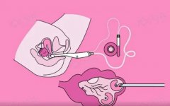 想要了解人工受孕取卵，看这一篇就够了！