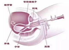 什么是宫腔镜检查和手术？有什么常见风险？