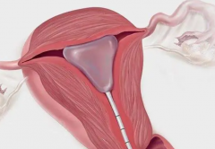 宫颈粘连对试管影响大吗？需根据情况来分析