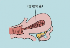 宫颈粘连状况下的试管可行吗？深入解析潜在影响与考量