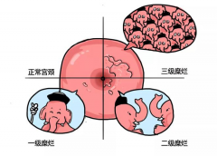 宫颈糜烂状态下试管成功率怎么样？了解影响成功率的关键因素