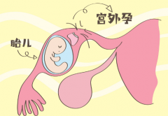 囊胚移植后为何还会宫外孕？三大幕后推手，一次说清楚！