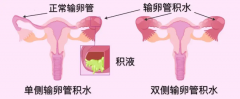 输卵管积水还能做试管吗？治疗方法与成功率解析！