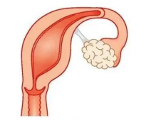 单角子宫试管能顺产吗？有风险但并非不可能